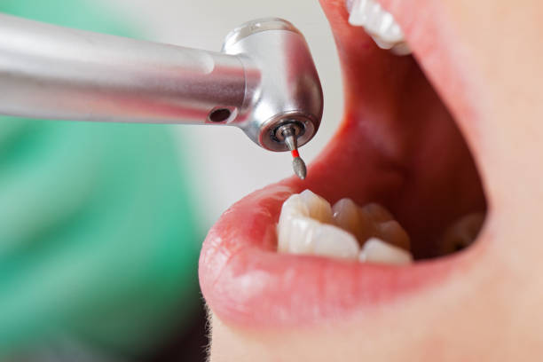 Best Emergency Dentist for Lost Fillings or Crowns in West Lawn, PA